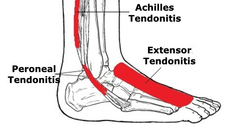 Does Stretching Help Foot Tendonitis